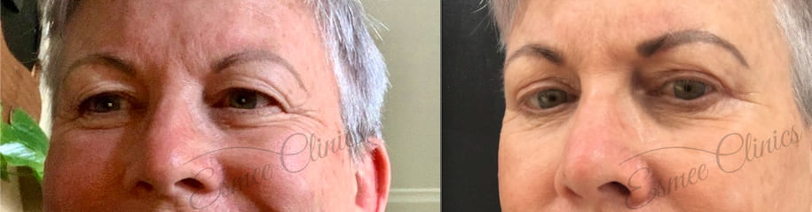 Before and After img